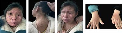 Case report: Xeroderma pigmentosum Group A with erythropoietic protoporphyria in a young Chinese patient